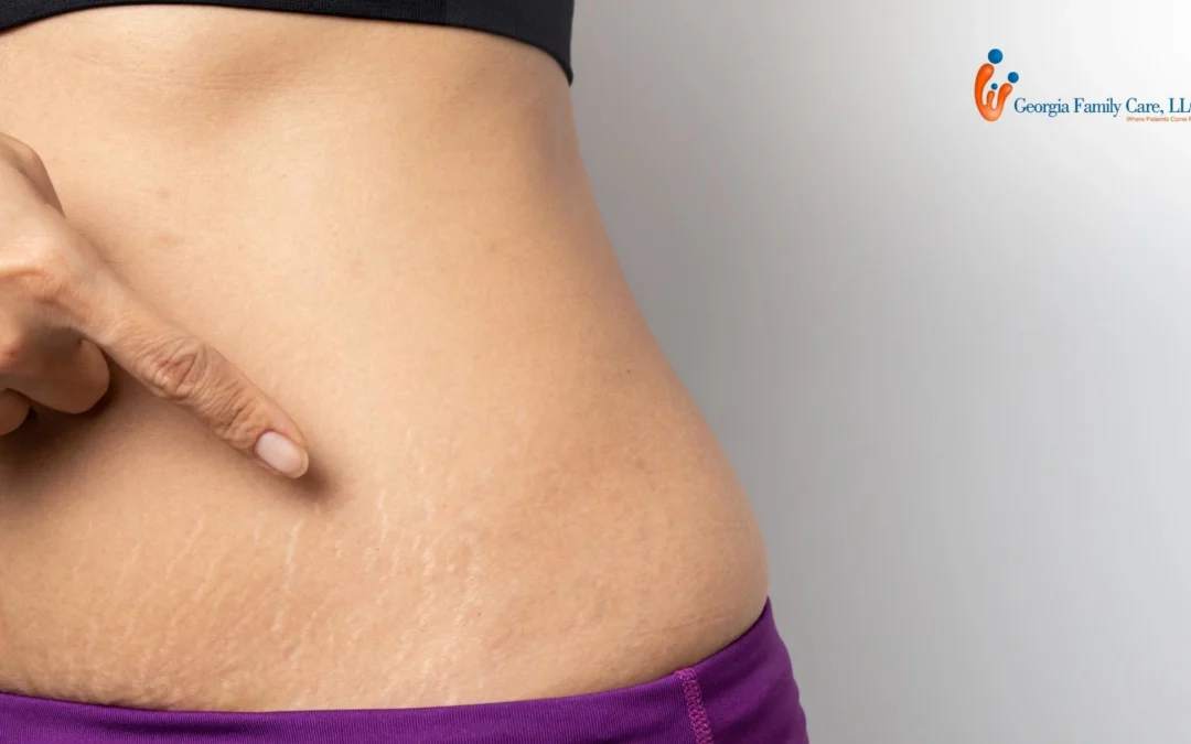 Can You Get Stretch Marks When You Lose Weight?
