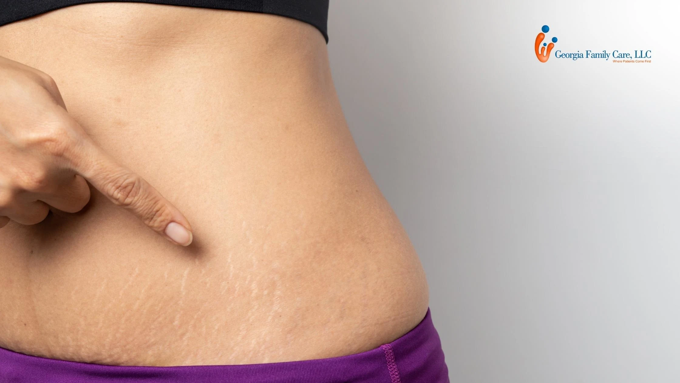 Woman pointing to stretch marks on her stomach after weight loss, showing skin texture changes treated at Georgia Family Care
